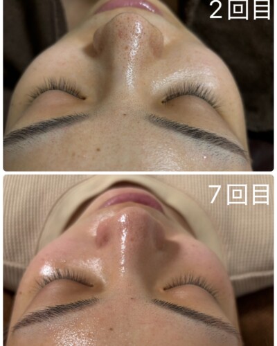 施術回数別違い