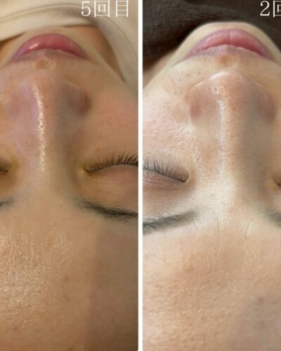 施術回数別違い