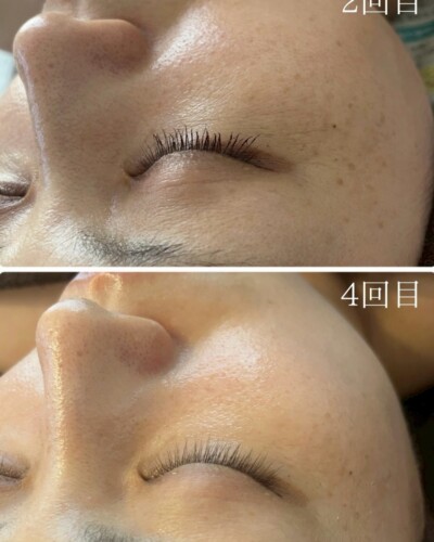 施術回数別違い