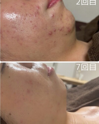 施術回数別違い